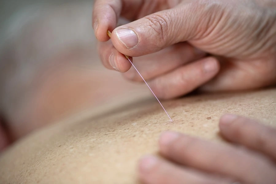 Dry-needling